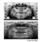 Caz implanturi dentare